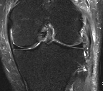 MRI Chronic Posterolateral Corner Reconstruction 2